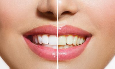 Before and after images of a woman's teeth, highlighting the effects of teeth whitening for a brighter smile.