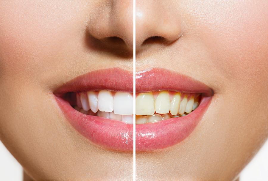 Before and after images of a woman's teeth, highlighting the effects of teeth whitening for a brighter smile.